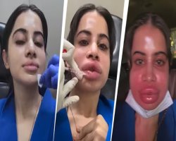 अरे! Urfi Javed को ये क्या हो गया? बुरी तरह से सूजा एक्ट्रेस का चेहरा, चेहरा बिगड़ने पर चर्चा में आईं Urfi Javed